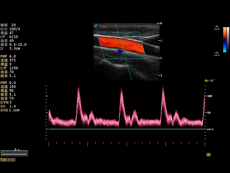 頸動脈PW